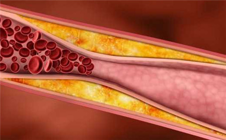 动脉粥样硬化斑块是什么疾病?